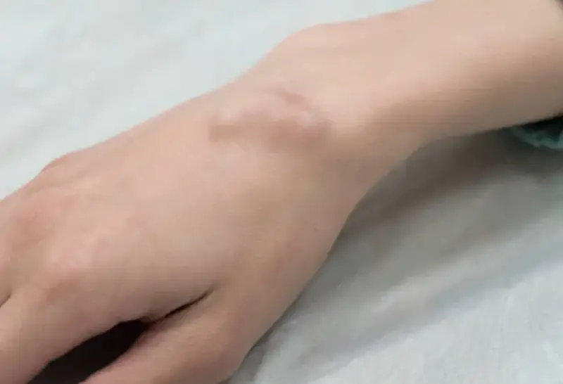 Ganglion Cyst